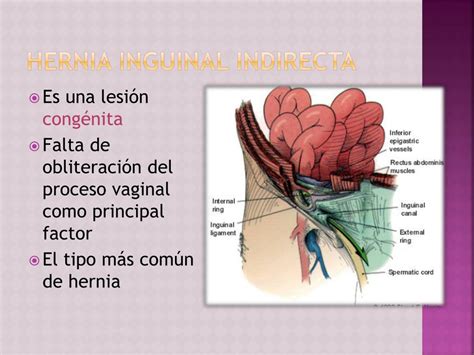 hernia inguinal indirecta que es